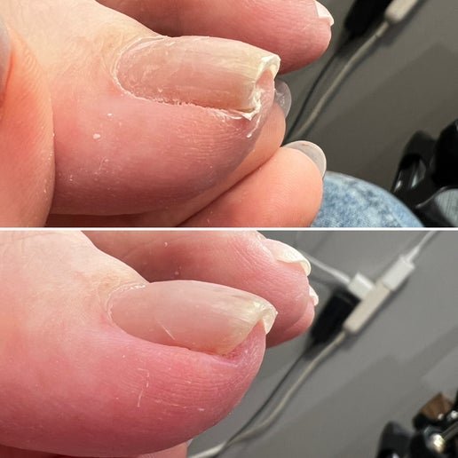 巻き爪補正（１本）