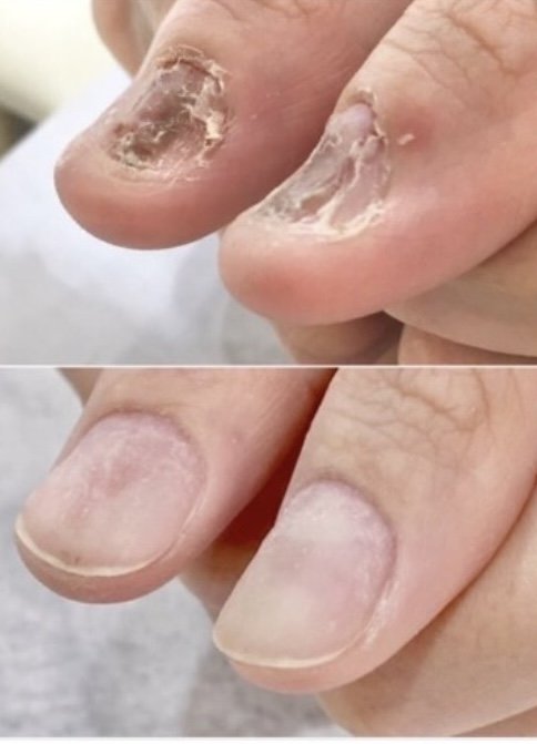 【育成】重度深爪矯正