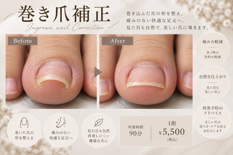 巻き爪補正(1指)